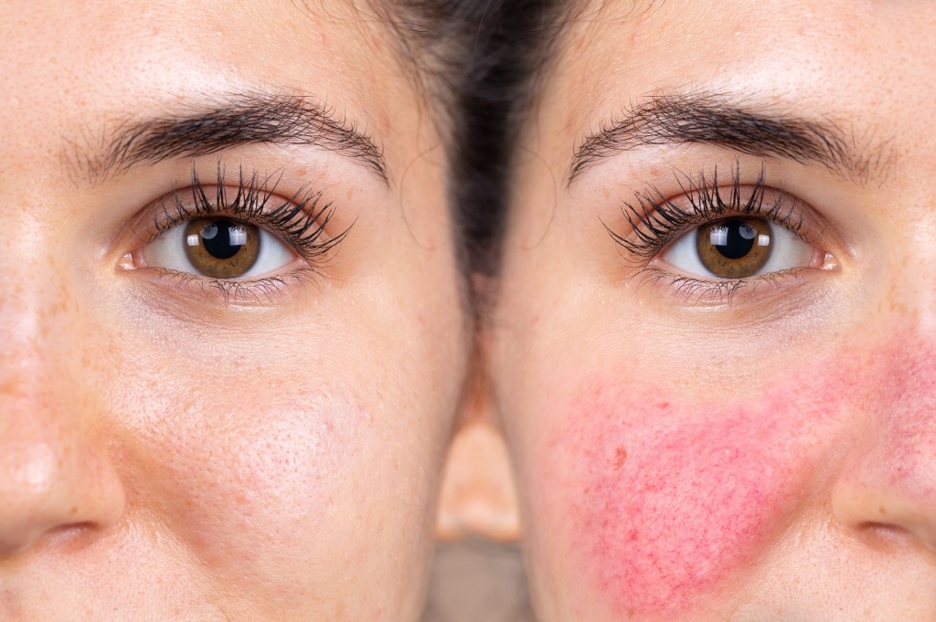 Reto de Conocimiento: Webinar Dermatitis Atópica